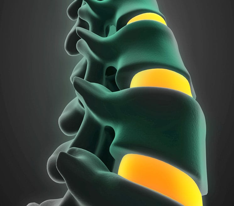 Discectomy, its Causes & Treatment - Physician Partners Of America
